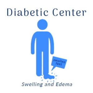 Nobile Shoes, Diabetic Center treats Swelling and Edema