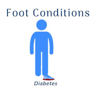 Nobile Shoes treats for foot conditions with Diabetes